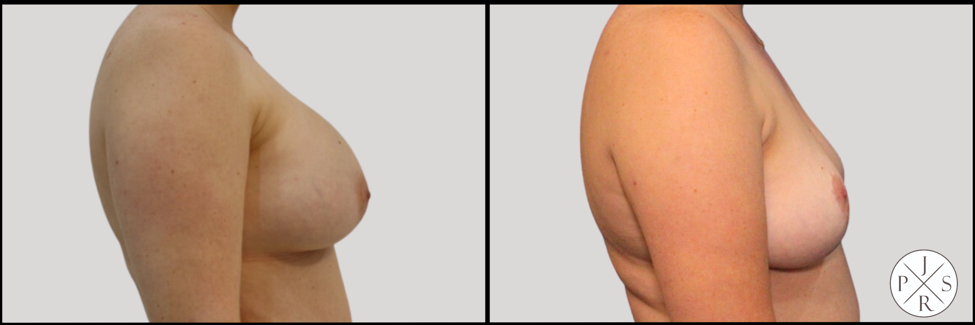 Breast Implant Removal Before & After Image